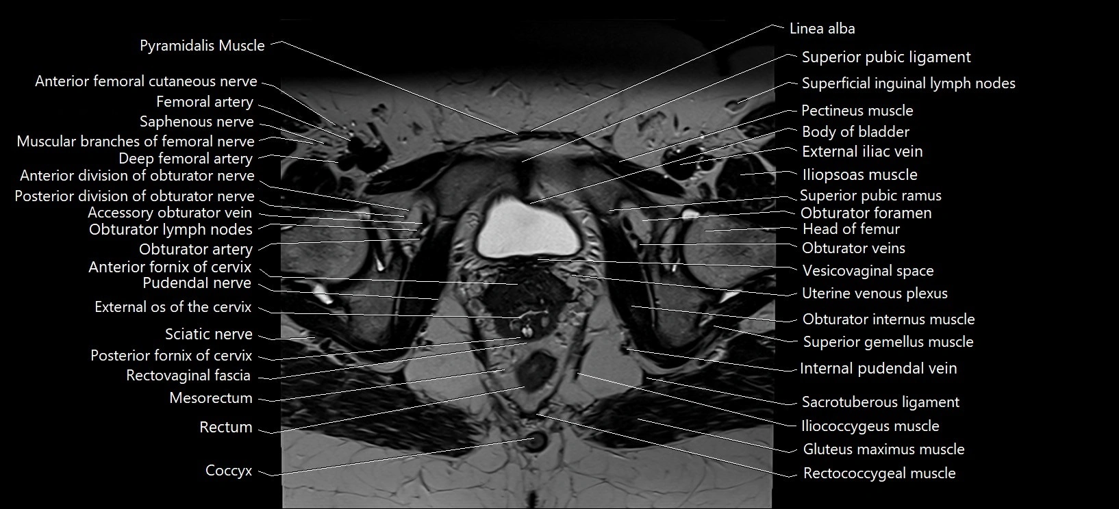 Axial cross sectional anatomy of female pelvis (MRI 3T) image 31.webp